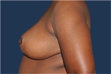 Breast Reduction After Photo by Jerry Weiger Chang, MD, FACS; Flushing, NY - Case 41843