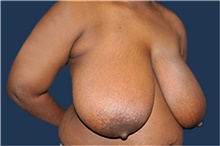 Breast Reduction Before Photo by Jerry Weiger Chang, MD, FACS; Flushing, NY - Case 41843