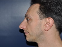 Rhinoplasty After Photo by Jerry Weiger Chang, MD, FACS; Flushing, NY - Case 41844