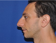 Rhinoplasty Before Photo by Jerry Weiger Chang, MD, FACS; Flushing, NY - Case 41844