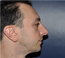 Rhinoplasty After Photo by Jerry Weiger Chang, MD, FACS; Flushing, NY - Case 41844