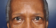 Eyelid Surgery After Photo by Jerry Weiger Chang, MD, FACS; Flushing, NY - Case 41845