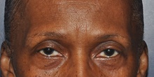 Eyelid Surgery Before Photo by Jerry Weiger Chang, MD, FACS; Flushing, NY - Case 41845