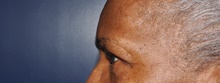 Eyelid Surgery After Photo by Jerry Weiger Chang, MD, FACS; Flushing, NY - Case 41845