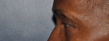 Eyelid Surgery Before Photo by Jerry Weiger Chang, MD, FACS; Flushing, NY - Case 41845