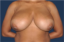 Breast Reduction Before Photo by Jerry Weiger Chang, MD, FACS; Flushing, NY - Case 41849