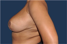 Breast Reduction After Photo by Jerry Weiger Chang, MD, FACS; Flushing, NY - Case 41849