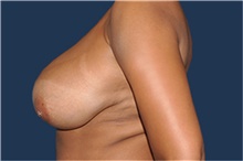 Breast Reduction Before Photo by Jerry Weiger Chang, MD, FACS; Flushing, NY - Case 41849