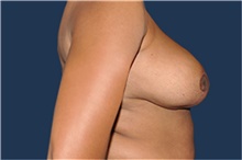 Breast Reduction After Photo by Jerry Weiger Chang, MD, FACS; Flushing, NY - Case 41849