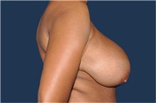 Breast Reduction Before Photo by Jerry Weiger Chang, MD, FACS; Flushing, NY - Case 41849