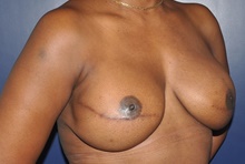 Breast Reconstruction After Photo by Jerry Weiger Chang, MD, FACS; Flushing, NY - Case 41850