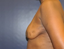 Breast Reconstruction Before Photo by Jerry Weiger Chang, MD, FACS; Flushing, NY - Case 41850