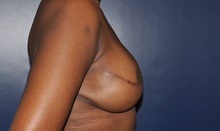 Breast Reconstruction After Photo by Jerry Weiger Chang, MD, FACS; Flushing, NY - Case 41850