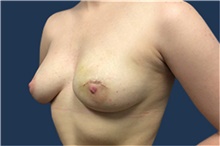 Breast Reconstruction Before Photo by Jerry Weiger Chang, MD, FACS; Flushing, NY - Case 41852
