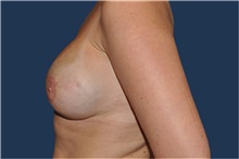 Breast Reconstruction After Photo by Jerry Weiger Chang, MD, FACS; Flushing, NY - Case 41852