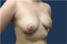 Breast Reconstruction Before Photo by Jerry Weiger Chang, MD, FACS; Flushing, NY - Case 41852