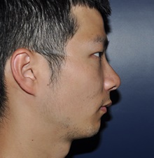Rhinoplasty After Photo by Jerry Weiger Chang, MD, FACS; Flushing, NY - Case 41853