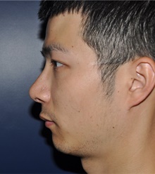 Rhinoplasty After Photo by Jerry Weiger Chang, MD, FACS; Flushing, NY - Case 41853