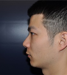 Rhinoplasty Before Photo by Jerry Weiger Chang, MD, FACS; Flushing, NY - Case 41853