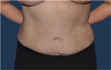Tummy Tuck After Photo by Jerry Weiger Chang, MD, FACS; Flushing, NY - Case 41880