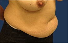 Tummy Tuck Before Photo by Jerry Weiger Chang, MD, FACS; Flushing, NY - Case 41880