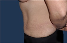 Tummy Tuck After Photo by Jerry Weiger Chang, MD, FACS; Flushing, NY - Case 41880