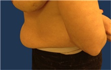 Tummy Tuck Before Photo by Jerry Weiger Chang, MD, FACS; Flushing, NY - Case 41880