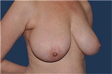 Breast Reduction Before Photo by Jerry Weiger Chang, MD, FACS; Flushing, NY - Case 41881