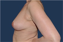 Breast Reduction After Photo by Jerry Weiger Chang, MD, FACS; Flushing, NY - Case 41881