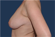 Breast Reduction Before Photo by Jerry Weiger Chang, MD, FACS; Flushing, NY - Case 41881