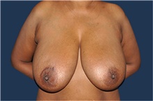 Breast Reduction Before Photo by Jerry Weiger Chang, MD, FACS; Flushing, NY - Case 41883