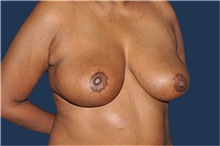 Breast Reduction After Photo by Jerry Weiger Chang, MD, FACS; Flushing, NY - Case 41883