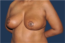 Breast Reduction After Photo by Jerry Weiger Chang, MD, FACS; Flushing, NY - Case 41883