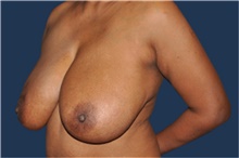 Breast Reduction Before Photo by Jerry Weiger Chang, MD, FACS; Flushing, NY - Case 41883