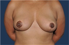Breast Reduction After Photo by Jerry Weiger Chang, MD, FACS; Flushing, NY - Case 41885