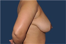 Breast Reduction Before Photo by Jerry Weiger Chang, MD, FACS; Flushing, NY - Case 41885