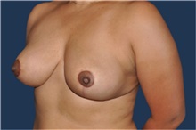Breast Reduction After Photo by Jerry Weiger Chang, MD, FACS; Flushing, NY - Case 41885