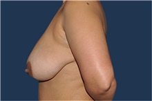 Breast Reduction Before Photo by Jerry Weiger Chang, MD, FACS; Flushing, NY - Case 41885