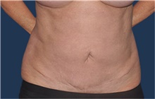 Liposuction After Photo by Jerry Weiger Chang, MD, FACS; Flushing, NY - Case 42526