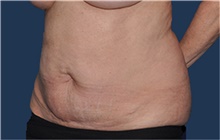 Liposuction Before Photo by Jerry Weiger Chang, MD, FACS; Flushing, NY - Case 42526