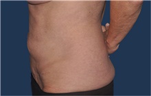 Liposuction After Photo by Jerry Weiger Chang, MD, FACS; Flushing, NY - Case 42526