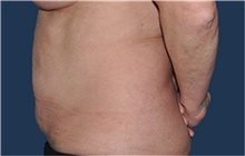 Liposuction Before Photo by Jerry Weiger Chang, MD, FACS; Flushing, NY - Case 42526