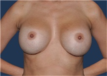 Breast Implant Revision After Photo by Jerry Weiger Chang, MD, FACS; Flushing, NY - Case 43262