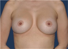 Breast Implant Revision Before Photo by Jerry Weiger Chang, MD, FACS; Flushing, NY - Case 43262