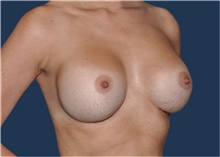 Breast Implant Revision After Photo by Jerry Weiger Chang, MD, FACS; Flushing, NY - Case 43262