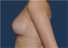 Breast Implant Revision Before Photo by Jerry Weiger Chang, MD, FACS; Flushing, NY - Case 43262