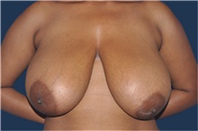Breast Reduction Before Photo by Jerry Weiger Chang, MD, FACS; Flushing, NY - Case 43263