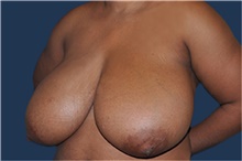 Breast Reduction Before Photo by Jerry Weiger Chang, MD, FACS; Flushing, NY - Case 43263