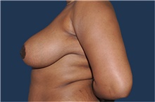 Breast Reduction After Photo by Jerry Weiger Chang, MD, FACS; Flushing, NY - Case 43263
