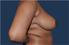 Breast Reduction After Photo by Jerry Weiger Chang, MD, FACS; Flushing, NY - Case 43263